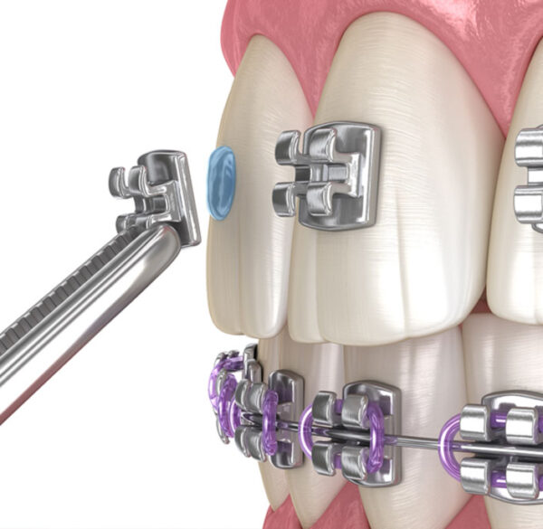 Braces Emergency Care Orthodontics Ltd Peoria IL